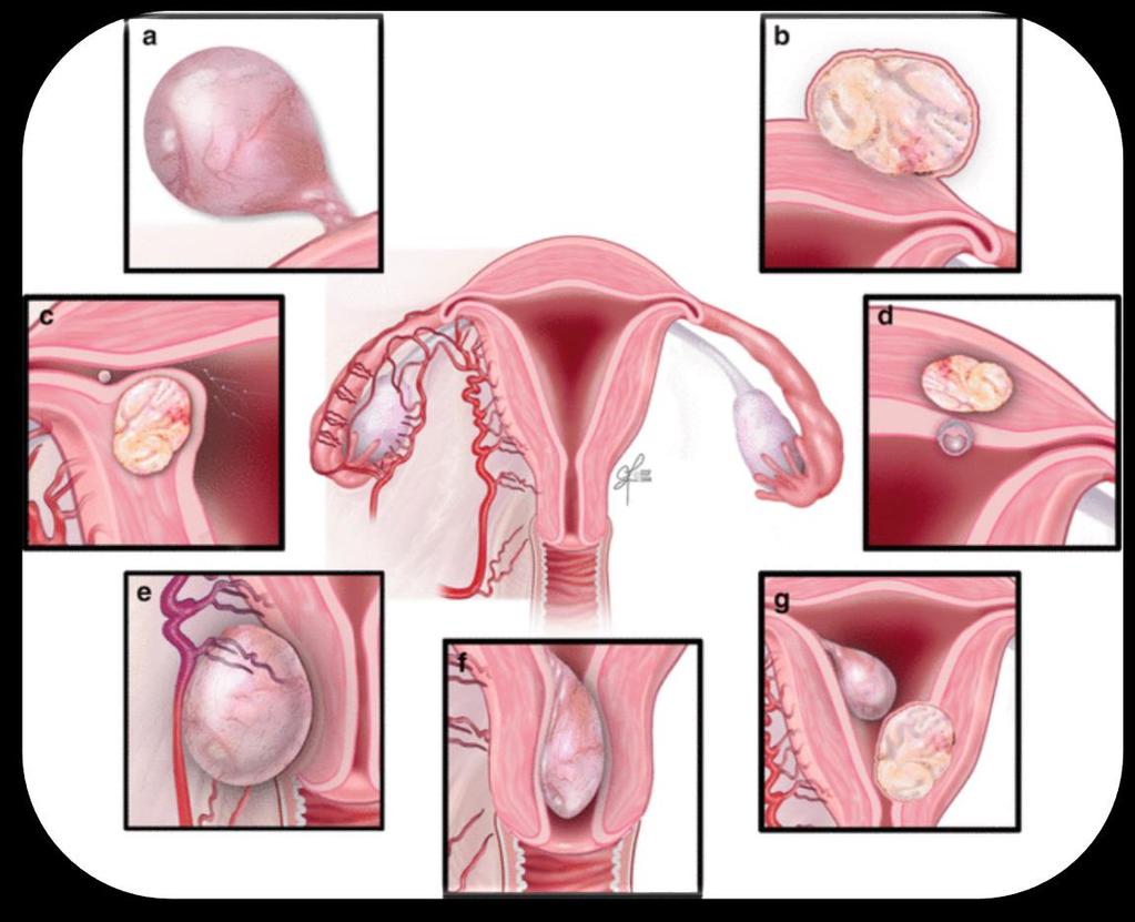 FIBROIDS AND FERTILITY Increased or disordered uterine contractility that may hinder sperm or embryo transport or nidation Altered tubo-ovarian anatomy, interfering with ovum capture Displacement of
