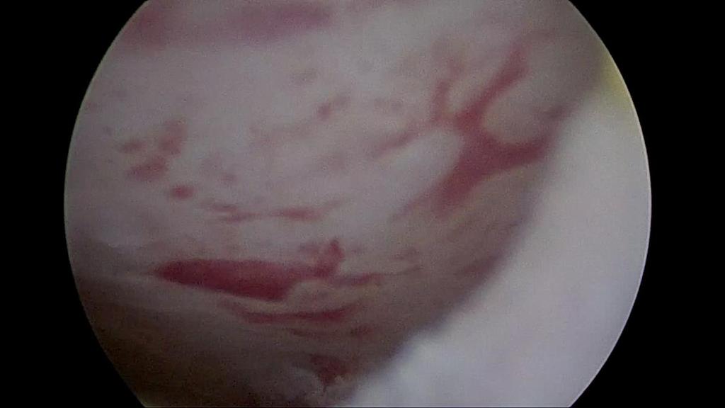 Patient for Hysteroscopy: 32 years old women, P=1, Ab=0, 1,5 years infertility, Sperm analyse good,