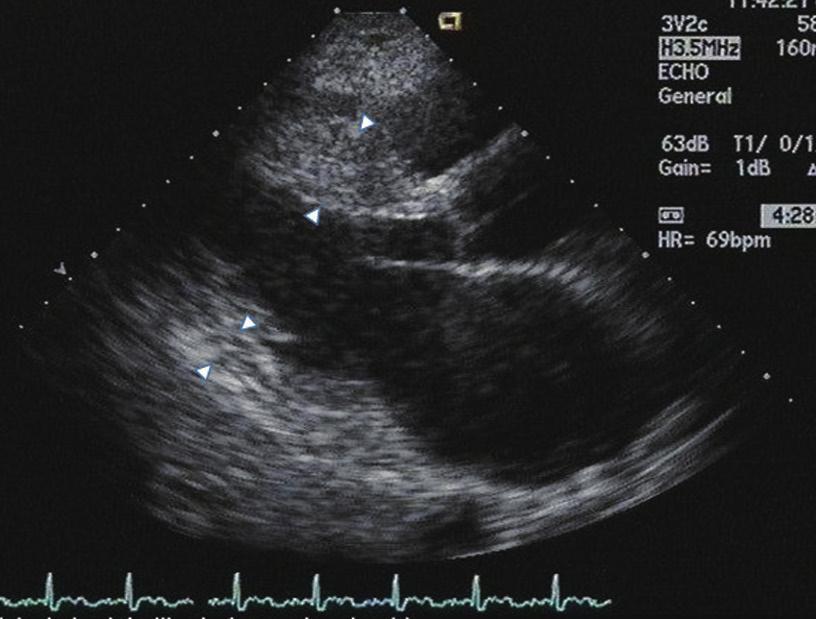 Dae-Won Sohn, et al. 415 D E Fig. 2. Upper panel; initial echocardiogram in patient 2. () bsence of septal hypertrophy.