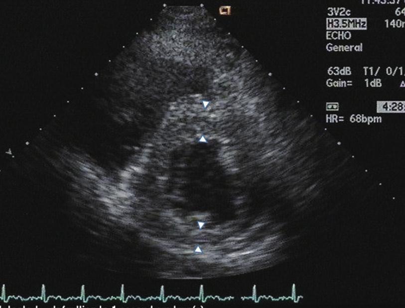 Lower panel; follow up echocardiogram done 9 years after the initial echocardiogram.