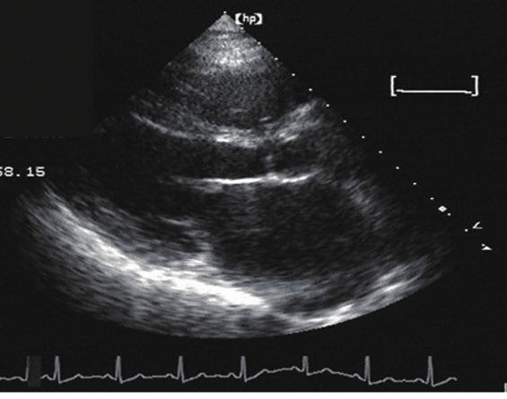 (E) pical 4 chamber view shows a couple of prominent trabeculations and deep recesses (arrows). Fig. 3. Initial echocardiogram of patient 3.