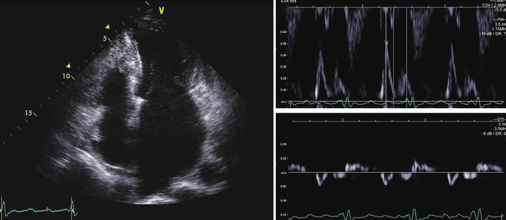 416 Inapparent Phenotype in Hypertrophic ardiomyopathy Fig. 4. Echocardiogram in patient 3 at the time of admission to neurology department due to stroke.