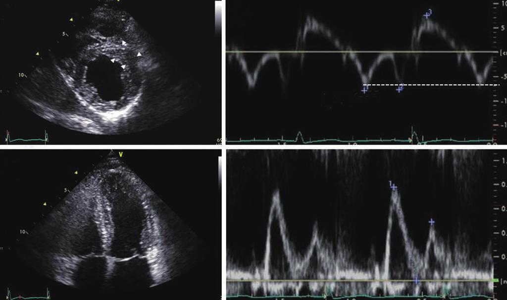() pical 4 chamber view showing marked left atrial enlargement. (, ) Mitral inflow and mitral annulus velocity profiles. 7 cm/sec D Fig. 5. Echocardiographic findings in patient 4.