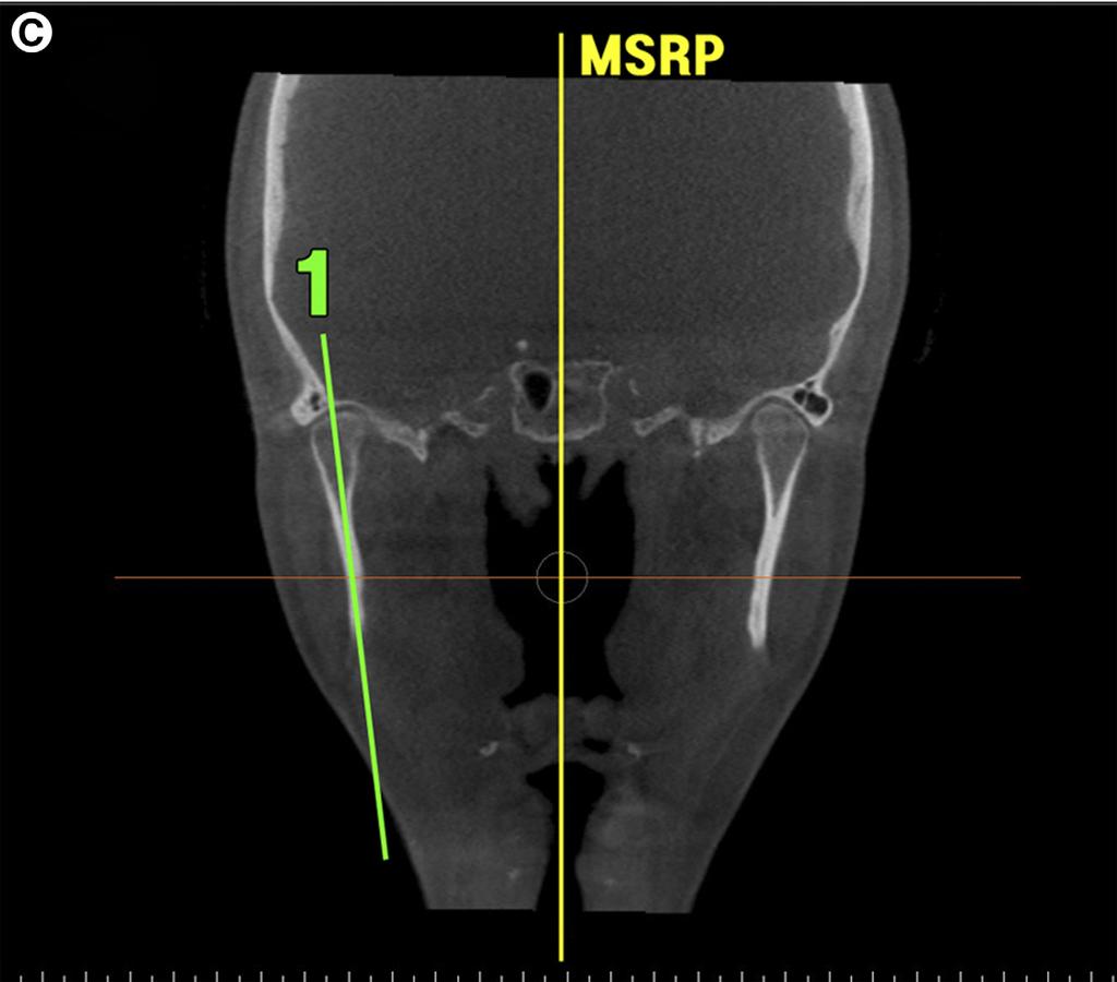 2148 CONDYLAR POSITIONING AFTER JAW SURGERY FIGURE 2 (cont d).