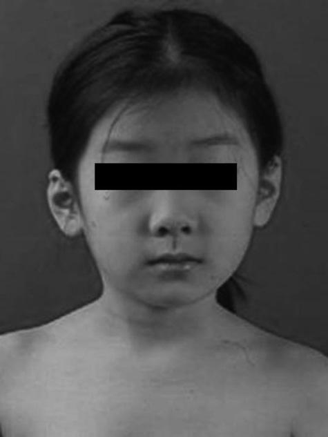 938 J. S. SHIM, H. P. JANG Fig. 2a Fig. 2b Fig. 2c Fig. 2d A six-year-old girl with right-sided congenital muscular torticollis. a) Pre-operative photograph and b) plain radiograph.