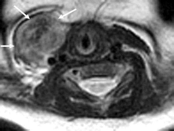 Jee Hyun Hwang, et al. Magnetic resonance imaging Most of the neck MRIs were performed in order to determine whether or not surgical release was required.