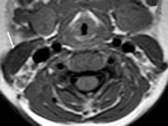 neck MRI: 59.63±103.55 months old; age range: 4 months-38 years).