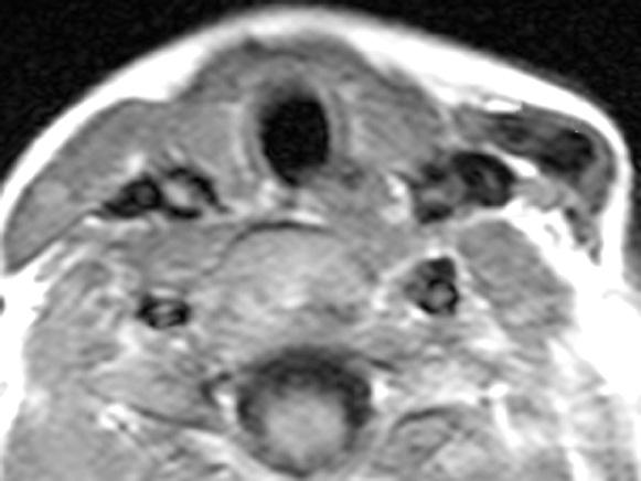 (CMT) showing a cord-like right SCM (arrows).
