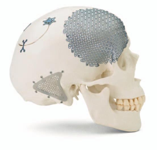 MatrixNEURO. The next generation cranial plating system. Introduction The aim of surgical fracture treatment is to reconstruct the bony anatomy and restore its function.