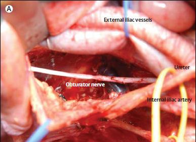 Lateral Lymph Node Disection The obturator fossa after lateral lymph node dissection, with the dissected fatty and connective