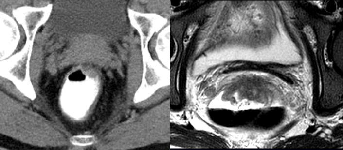 CT VS MRI CT =Inferior Contrast Resolution Adapted from