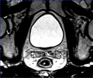NORMAL MRI ANATOMY T2 Axial Inner High Signal - Mucosa/Submucosa Middle Low Signal Muscularis Propria