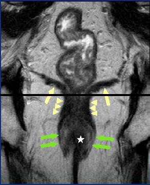 T2 CORONAL MR-Coronal The levatoranimuscle (yellow arrows) and puborectalismuscles (arrow heads).