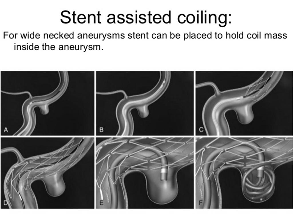 STENTS AND FLOW