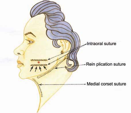 , D, Postoperative views 2 years after a primary face and neck lift with supra SMS and