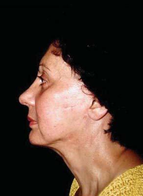 the SMS and platysma muscle, forehead lift, blepharoplasty, rein plication, corset