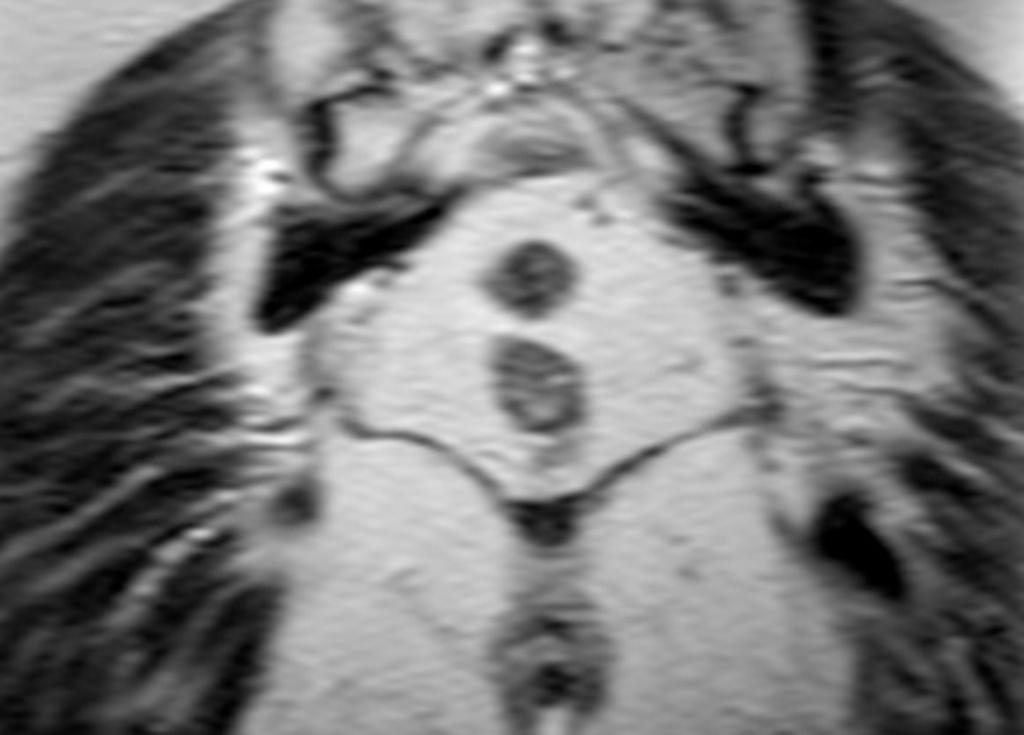 Fig. 2: T2 W image, coronal view MID - Section of Diagnostic