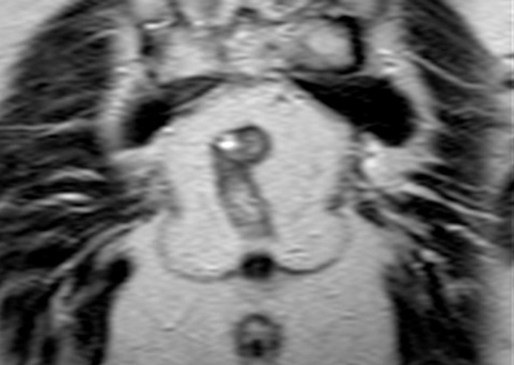 Fig. 3: T2 W image, coronal view during straining.