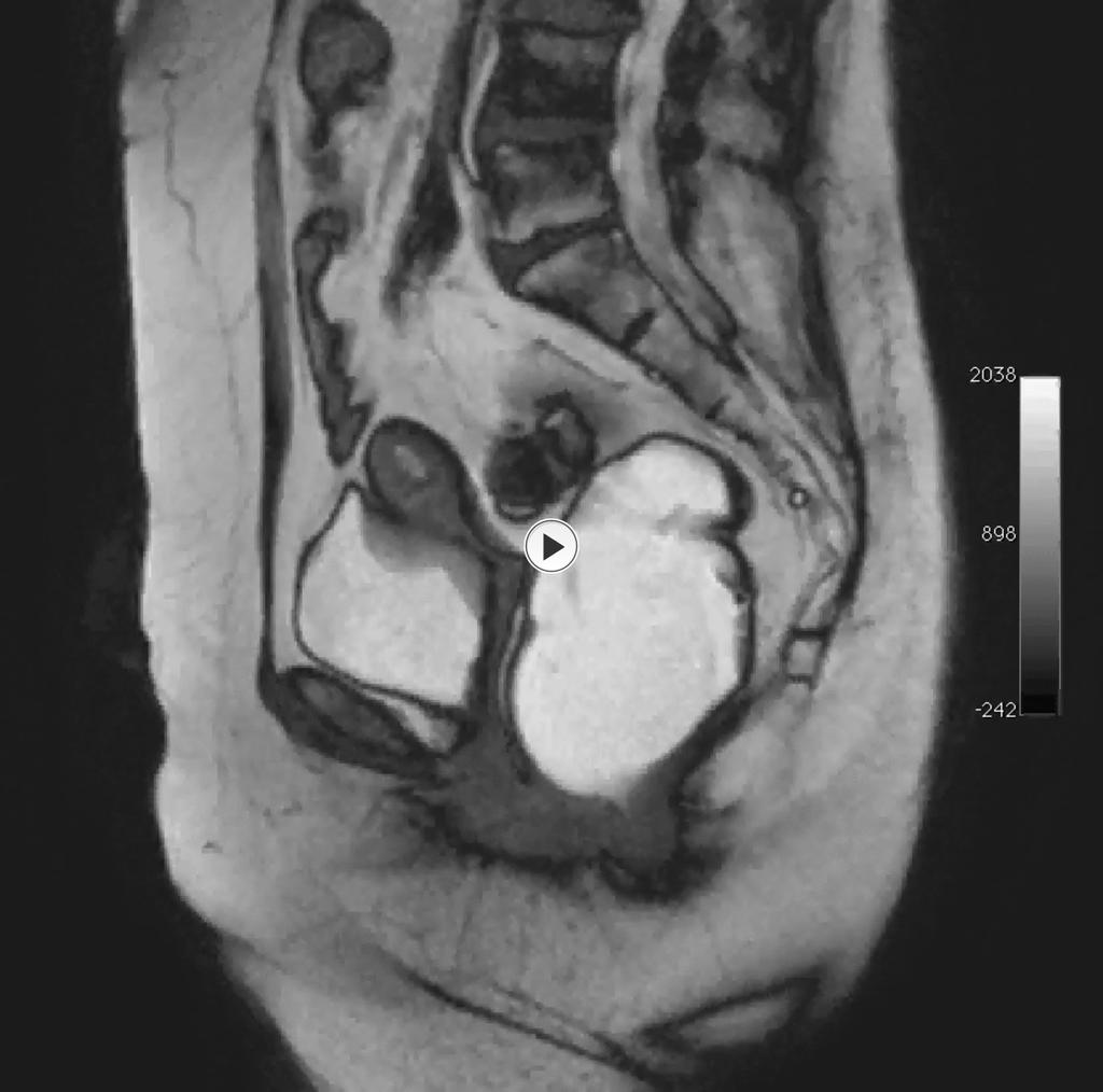 Fig. 4: Dynamic pelvic MRI.