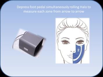 Halo and Halo Pro - Treatment Basics To activate the Halo measuring feature, the foot pedal is depressed simultaneously as the roller closest to the illuminated red light of the device is in constant