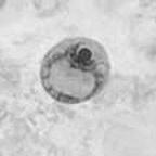 Example 7 contains a single cyst with two of the four karyosomes visible. Also note what appears to be a vacuole; this can occasionally be confused with an Iodamoeba bütschlii (single nucleus only).