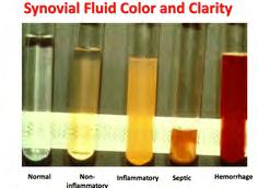 Synovial Fluid I usually ask for: Cell Count and Differential Crystal Analysis Gram Stain and Culture if