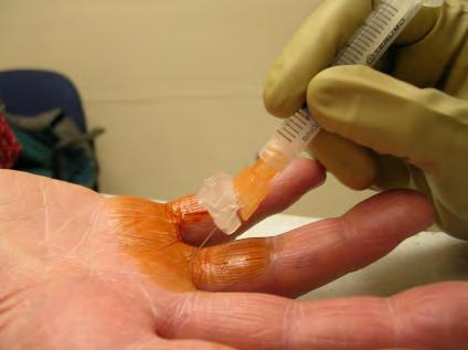 Trigger Finger Injection 3ml Syringe 25g needle (5/8 to 1 ) 10 20mg