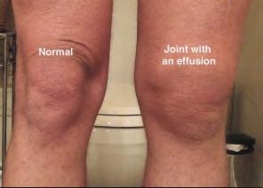 Knee Joint Aspiration / Injection Reasons to Aspirate Undiagnosed effusion Suspicion for