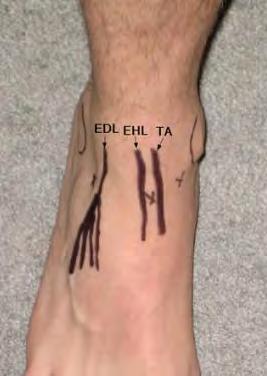 Ankle Aspiration / Injection