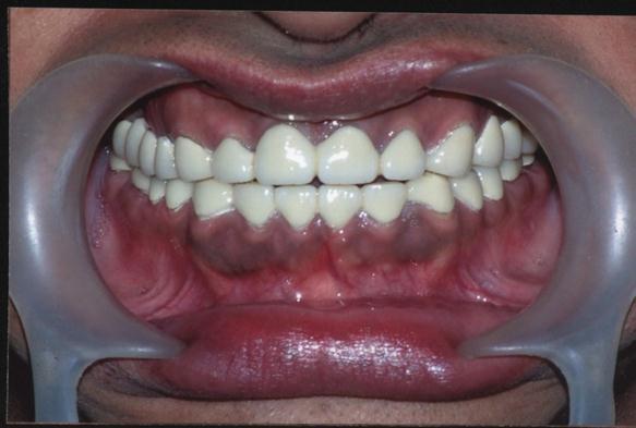 patient s mouth Fig 9: Crown