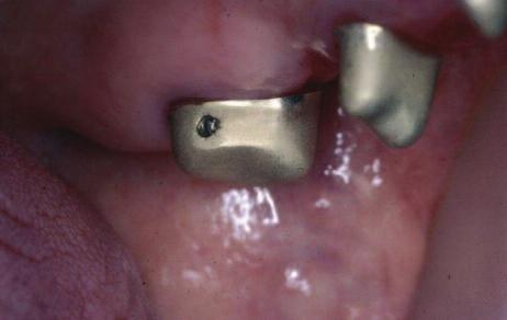 The end abutment is prepared so that it is tilting distally, allowing for a distal path of insertion of the coping.
