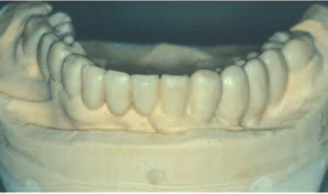 Figure 13: Diagnostic waxing performed. Figure 14: Tooth preparation guide.