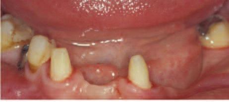 Should extra tooth preparation not be completed then an over-contoured bridge or one that shows excess