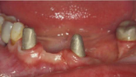 fixed bridges in patients with reduced periodontal tissue support.