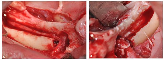 Figure 5c and 5d: Posterior mandibular