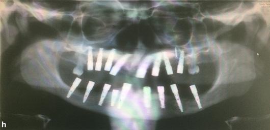 115 Figure 5h: Panoramic radiograph with full mouth implants at the end of the second surgery.