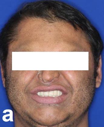 Figure 6b to figure 6d: Fixed prosthesis over the implants, intraoral views; Occlusion (6b), Maxillary arch (6c), Mandibular arch (6d).