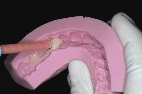 tooth-colored provisionl resin composite.