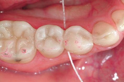 reduce excess resin composite in the emrsures.