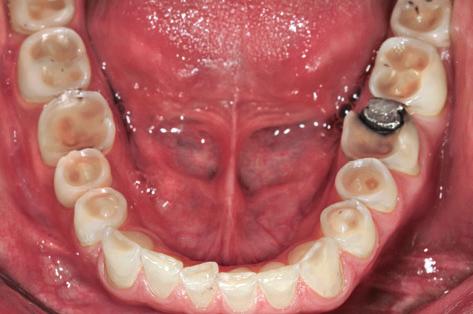 Even in cses of extensive dentine
