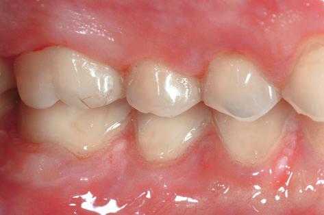 were restored with interim posterior resin composite (second