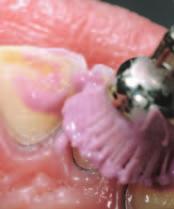 The dentin will e susequently clened, followed removing the most superficil lyer with dimond ur. e tht, due to the erosive process, cervicl chmfer-like preprtion is lredy present.
