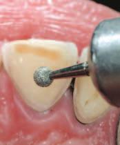 If the interocclusl distnce etween the nterior teeth is, insted, significnt, free-hnd resin composites could prove to e very chllenging.