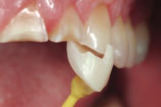 VAILATI/BELSER Puliction Fig 8 nd To fcilitte the positioning during onding of the pltl onlys, smll hook is fricted. This incisl stop will e removed esily during finishing nd polishing.