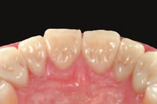In this ptient, the full length of the future veneers ws reconstructed t this intermedite stge