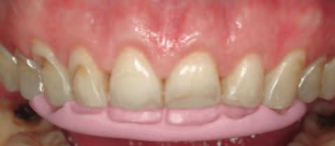 As the position of the occlusl plne nd the increse of VDO my e slightly different from wht ws initilly plnned, the length of the mxillry nterior teeth should e reconfirmed during the second mock-up