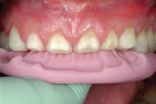 c Fig 17 to c Three different ptients fter veneer preprtion with the silicone key in