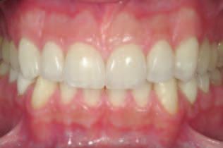 whether or not to remove the entire length dded with the resin composite or to leve prt of it ee restoring the teeth with the fcil veneers.