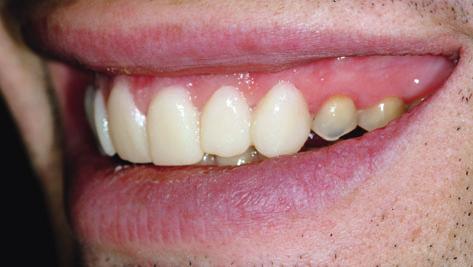 estheticlly plesing. proposed the use of mockup veneer restortions of nterior teeth.