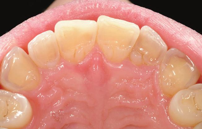 An erly conservtive rehilittion ws plnned, nd ll mxillry nterior teeth were restored using n indirect pproch (pltl veneers), while the posterior teeth received direct composite restortions.